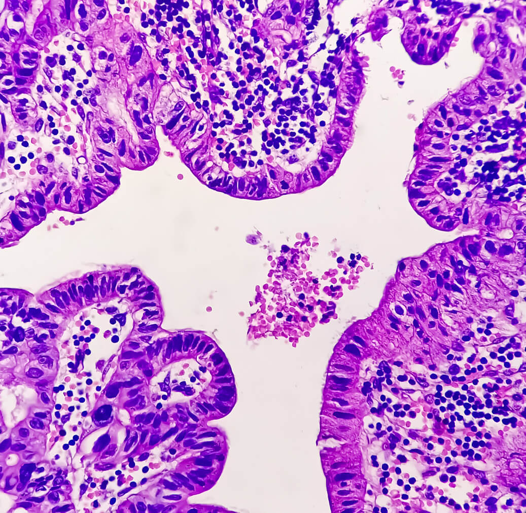 Defnyddio technolegau newydd i nodi biofarcwyr newydd ar gyfer cael diagnosis ar gyfer clefydau’r ysgyfaint a’u monitro (NovelTech) Blood Cells